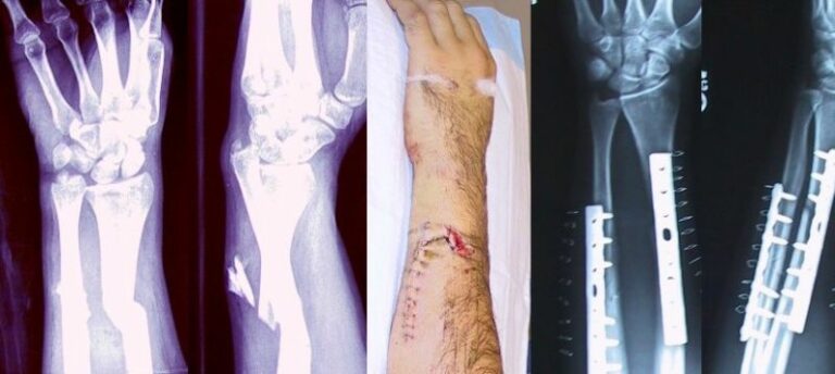 Broken Fixed Arm