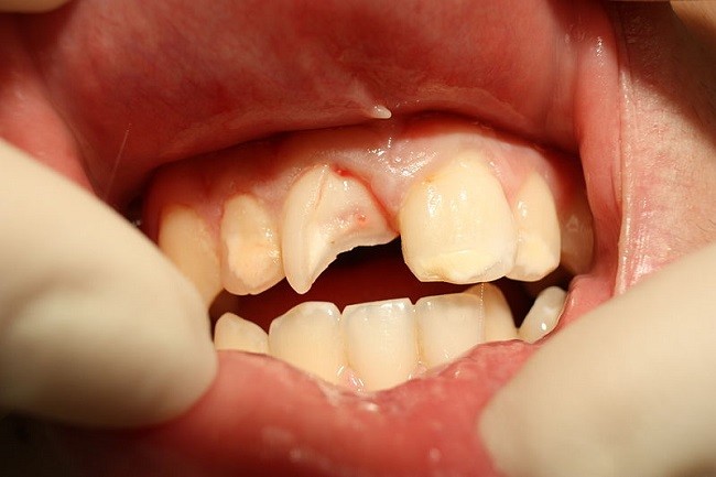 Penyebab gigi kuning