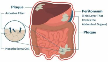 Mesothelioma, Kanker Paling Berbahaya dan Mematikan ...