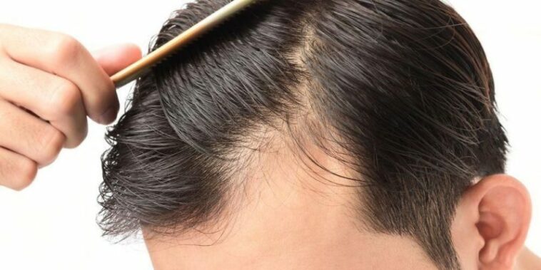 5 Cara Cepat Menumbuhkan Rambut Dengan Ramuan Alami