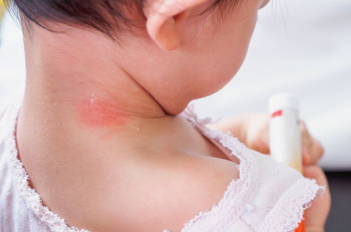 Mengatasi Alergi Kulit Pada Bayi