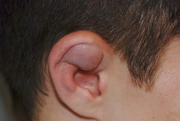 Auricular Hematoma