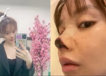 Niat Hati Punya Hidung Sempurna, Tapi Hidung Wanita Ini Membusuk Pasca Operasi